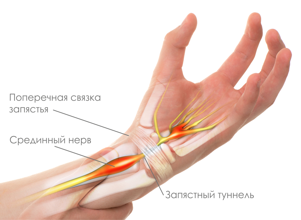 Немеет левая рука причины и лечение. Синдром запястного канала (карпальный туннельный синдром). Туннельный синдром запястья мкб. Туннельный синдром срединного нерва. Синдром карпального канала на рентгене.